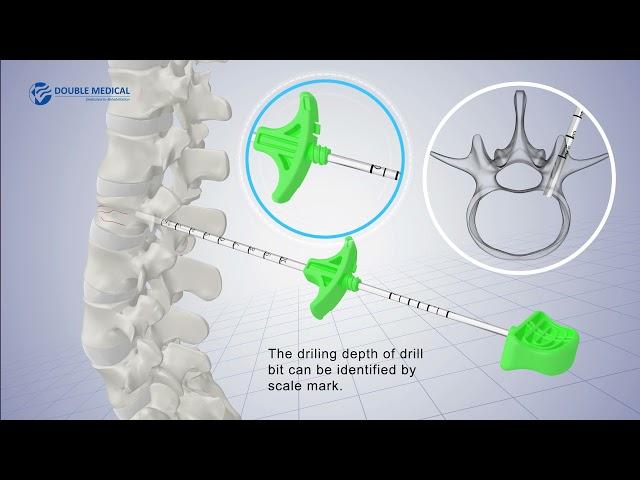 PKP Percutaneous Kyphoplasty System (PKP)