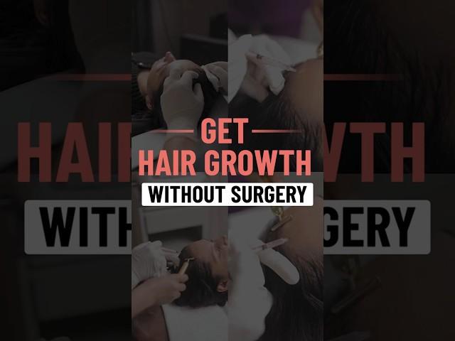 Get Hair Growth Without Surgery | Hair Transplant in delhi #shorts #hairgrowth #hairtransplant