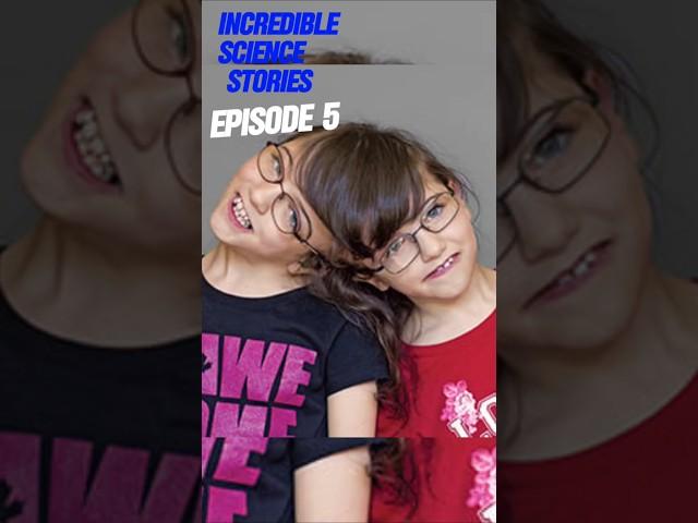 The Twins Who Shared a Brain:Tatiana and Krista Hogan's Incredible Story#IncredibleScientificStories