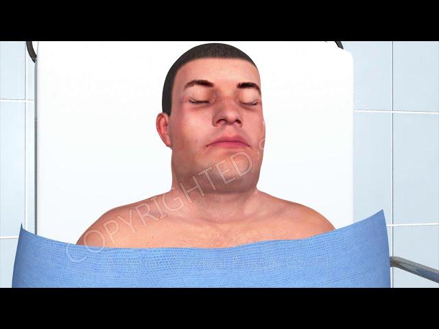 Cervical Discectomy and Fusion Animation C5 - T1