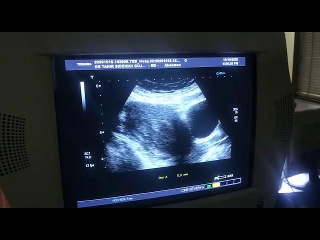 ENDOMETRIAL POLYP