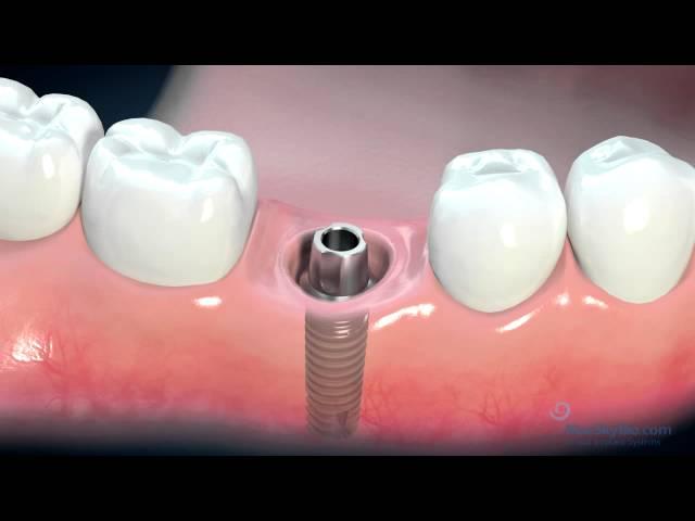 Dental Implant Consent Video