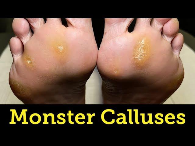 SHAVING OF GINORMOUS PAINFUL PLANTAR CALLUSES AND CORNS