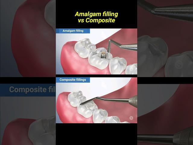 Amalgam filling vs composite #dentist #dentisty #filling