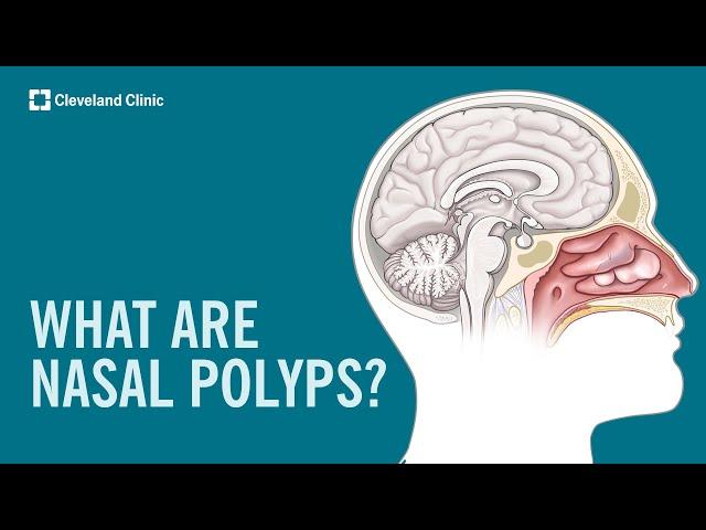 What Are Nasal Polyps?