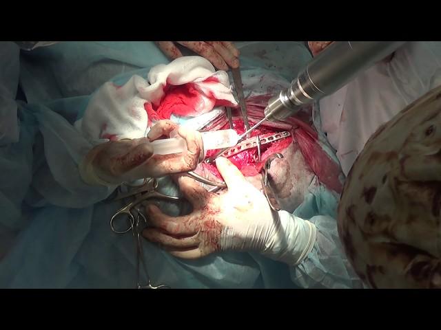 32A2 femoral fracture in a dog