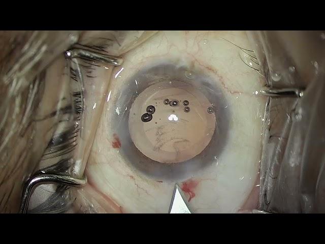 Loading and Implantation of multipiece IOL