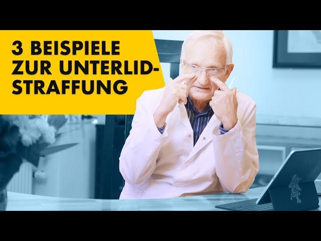 3 typische Fallbeispiele der Unterlidstraffung! Vorher Nachher Bilder erklärt | Dr. Jungwirth