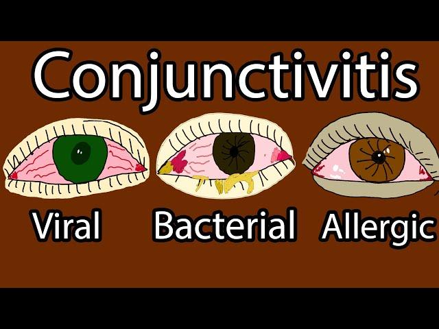 Pink Eye (Conjunctivitis) - Viral, Bacterial and allergic conjunctivitis. Symptoms and treatment