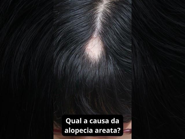 Qual a causa da alopecia areata #autoimmunedisease