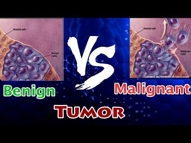 Benign Tumor Vs Malignant Tumor ( Clear Comparison )