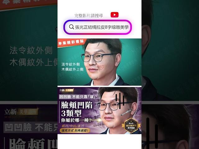 臉頰凹陷依賴填補  臉變大又下垂！　3類型頰凹填充方式大不同   別再選錯了  療程3D動畫 19-20240123