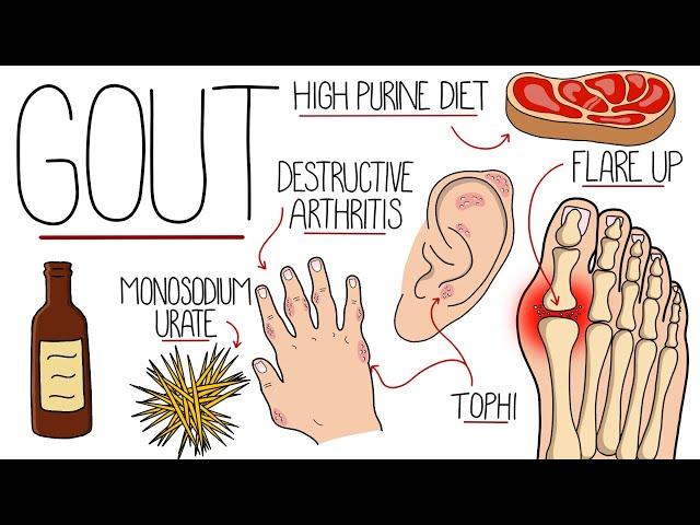 Understanding Gout (Gout Explained Clearly)