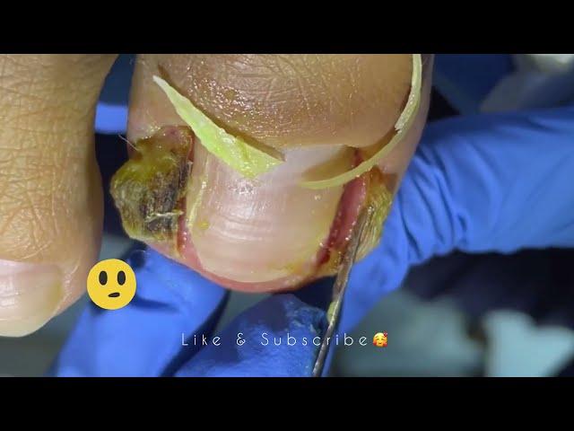 Cut Dirty Ingrown Toenail 剪大脏向内生长脚趾甲 #shorts #video #health