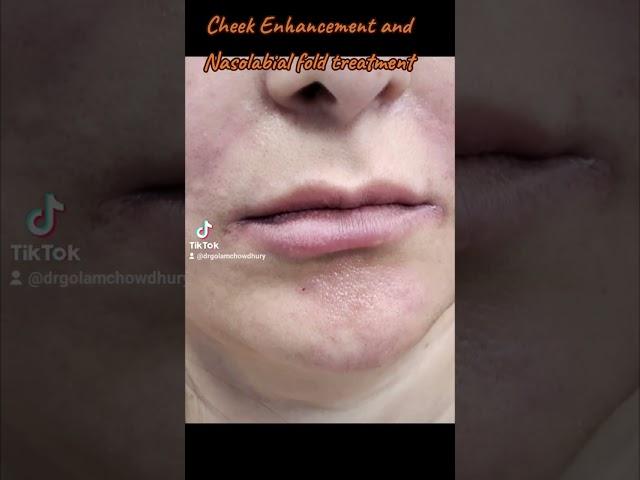 CHEEK ENHANCEMENT AND NASOLABIAL FOLD TREATMENT. (BEFORE AND AFTER)