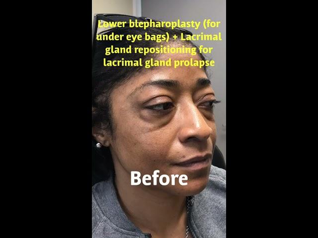 African American Lower Blepharoplasty-- Dr. Mehryar Taban-- CALL 310-299-8313