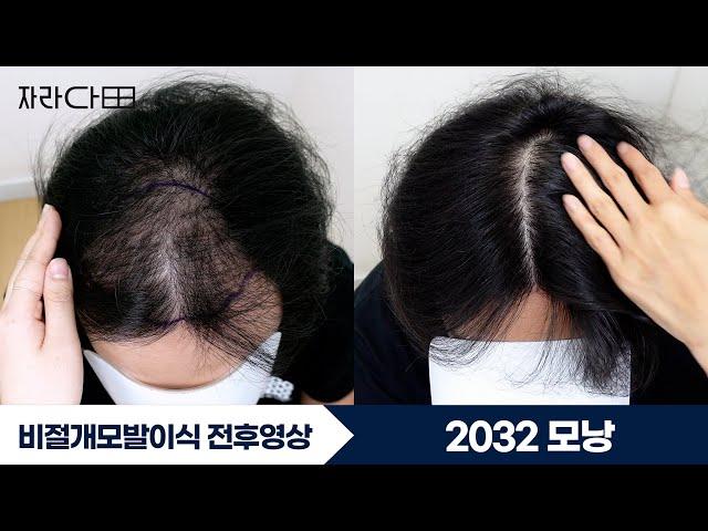 2032모낭 비절개모발이식 헤어라인 전두부 #자라다의원