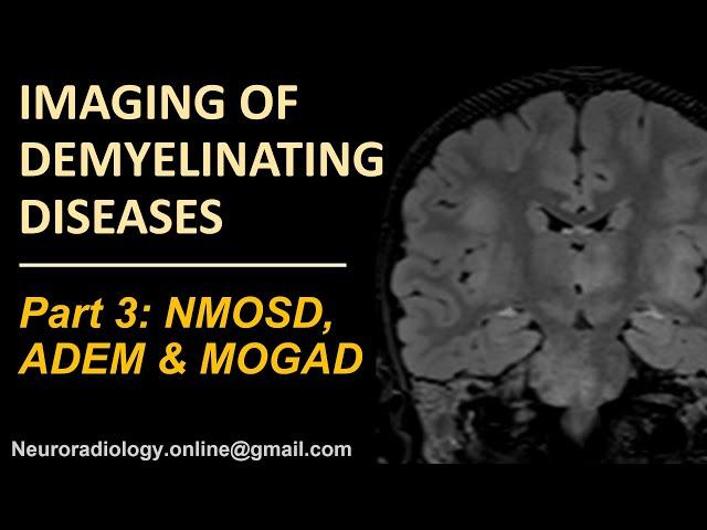 Imaging of demyelinating disorders (part 3) - NMOSD, MOGAD and ADEM