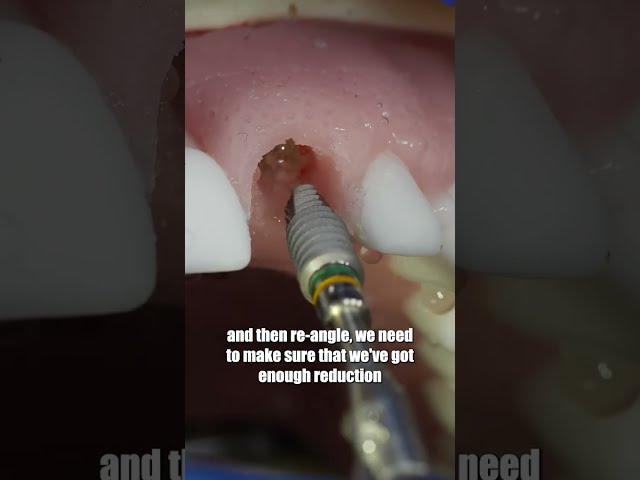 HOW TO: Immediate Implant - With Dr Lincoln Harris