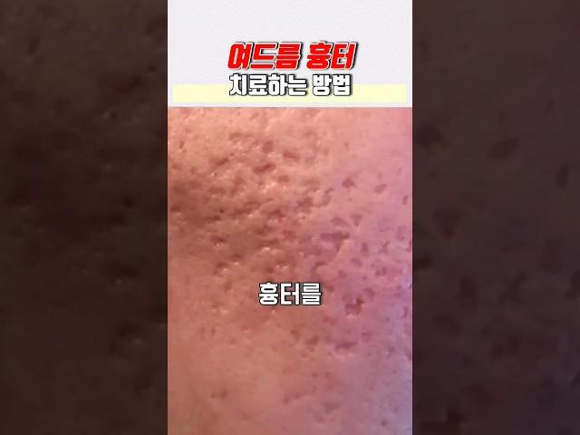 여드름 흉터 치료하는 방법 #패인흉터 #박스카 #박스흉터 #boxcar #boxscar