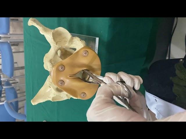 Manual vacuum aspiration | Dr. Shahlla Kanwal |