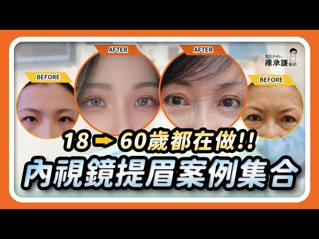 眼睛無神？內視鏡提眉手術18~60歲都說有效！ | 陳承謙醫師