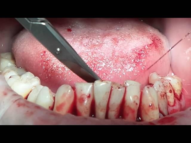 24 May. Mariia Nosova. Splinting and Periodontal Surgery. Part 5