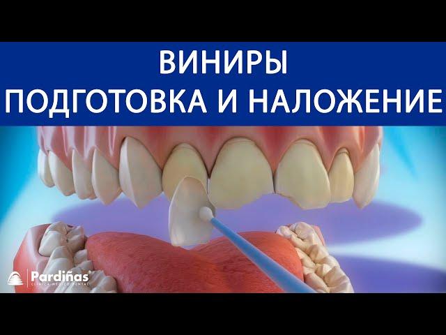 Виниры - Подготовка и наложение ©