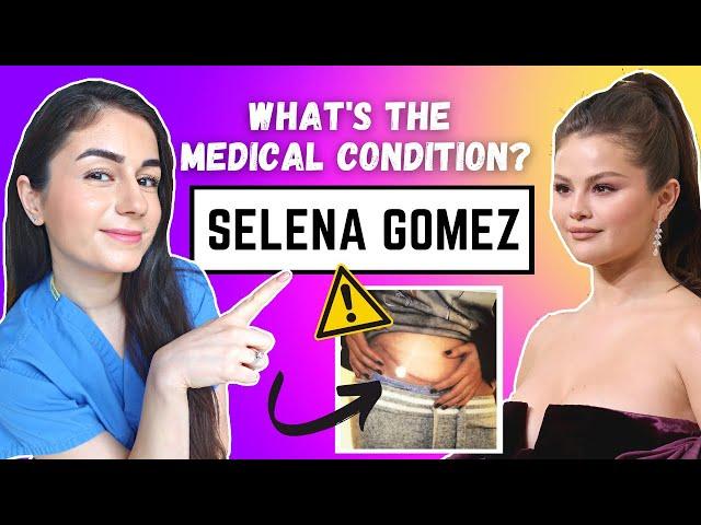 Lupus - Selena Gomez | Dr Ezgi Ozcan