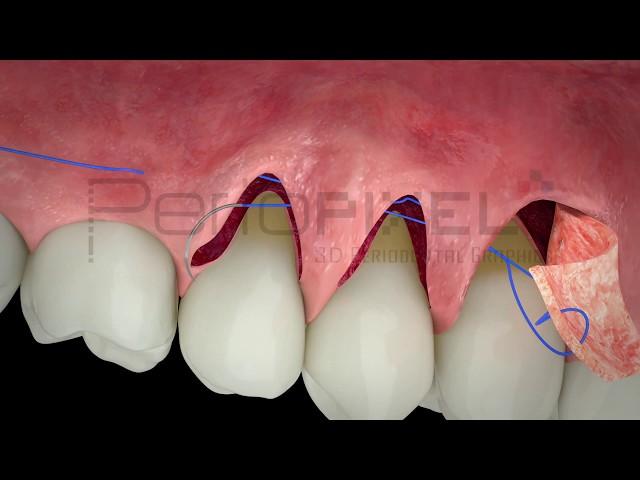 Tratamiento de múltiples recesiones gingivales adyacentes mediante ITC en túnel