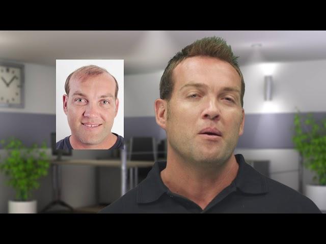 Jacques Kallis' hair replacement procedure by Advanced Hair Studio