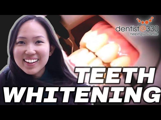 Teeth Whitening Procedure Step By Step || How Teeth Whitening Is Done?