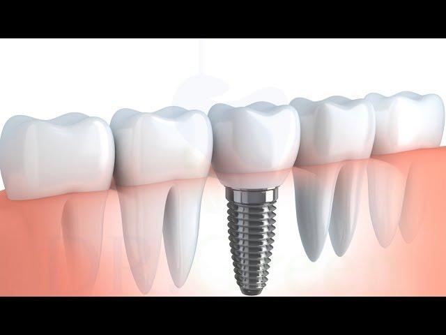 Implant treatment procedure