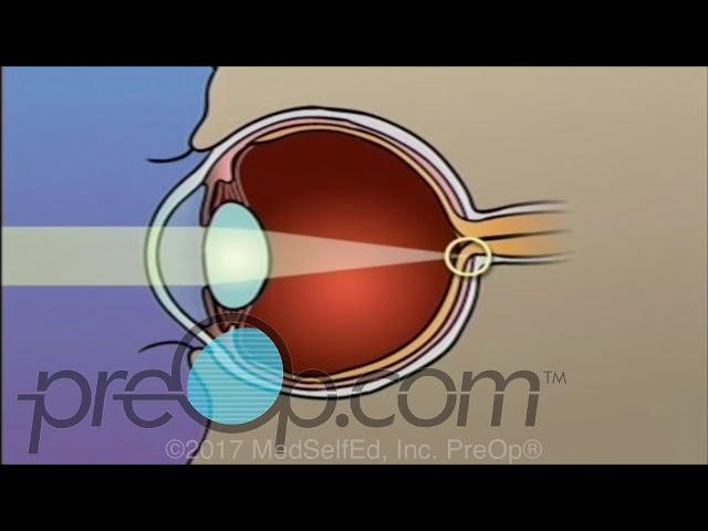 LASIK Laser Eye Surgery • Patient Education