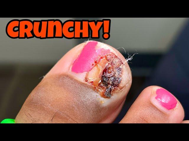 INFECTED INGROWN TOENAIL EXTRACTION