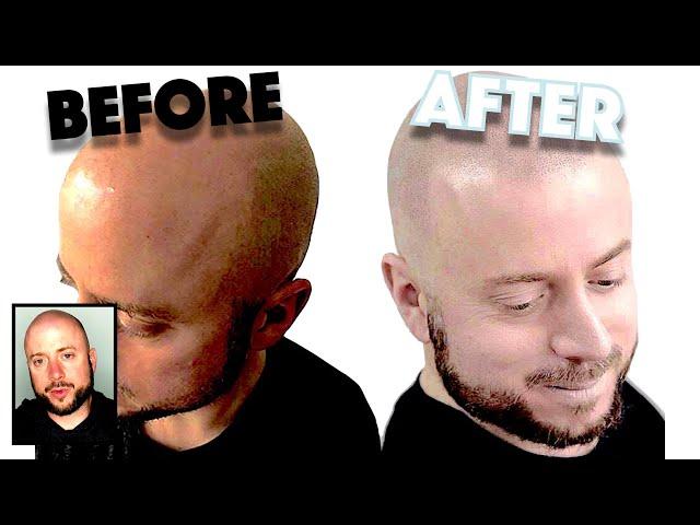 Yvette Greenall changes Dave's look through Scalp Micropigmentation in Ink 2 Scalp Studios