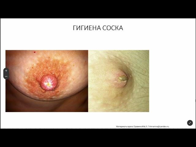 Что с сосками? что это может быть в области соска