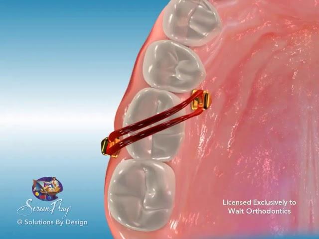 Tads Molar Intrusion