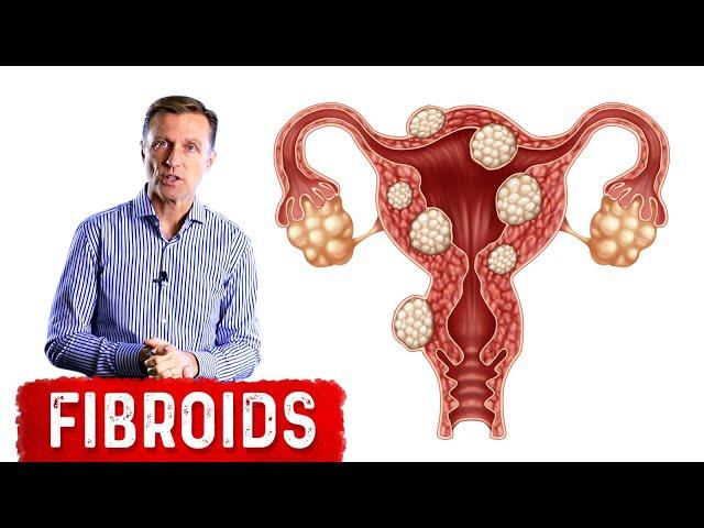 The Best Foods to Shrink Fibroids