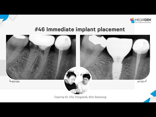 Dr. Yongseok CHO, Sewoung KIM, #46 Immediate implant placement surgery and prosthesis