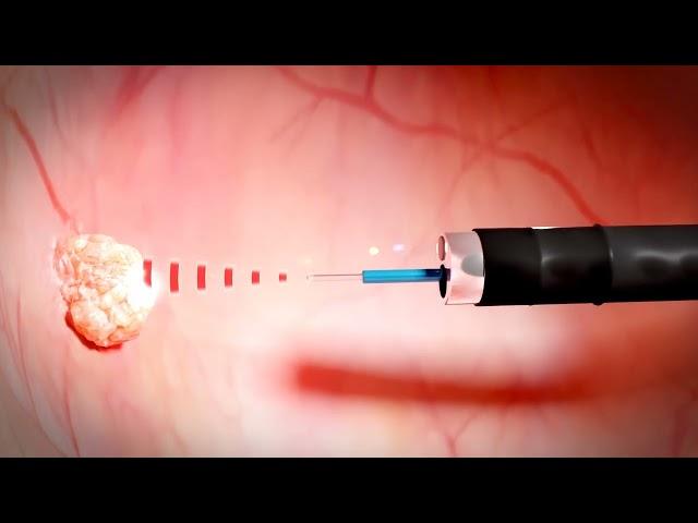 biolitec medical laser: TULA procedure