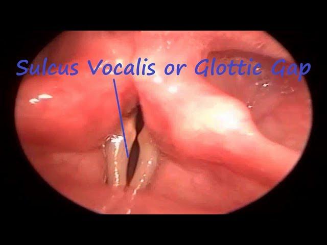 Sulcus Vocalis or Glottic Gap on Rigid Video Laryngoscopy