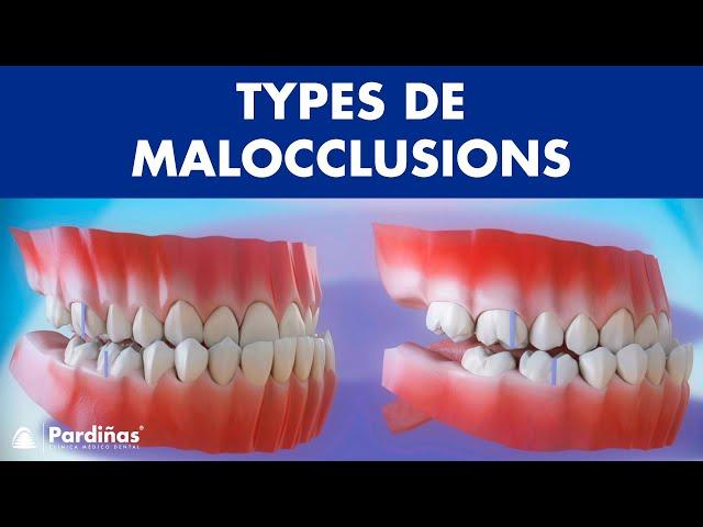 Malocclusion – Types de malocclusions dentaires ©