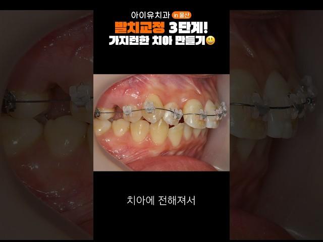 교정 고무줄로 발치 공간 메우기 #shorts