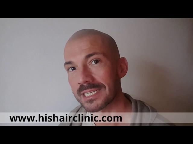 Karl’s Scalp Micropigmentation Review - HIS Hair Clinic for Hair Loss