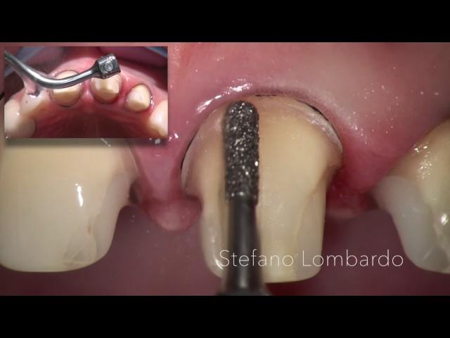 Chamfer vs BOPT: Lithium Disilicate adhesive crowns, by Stefano Lombardo