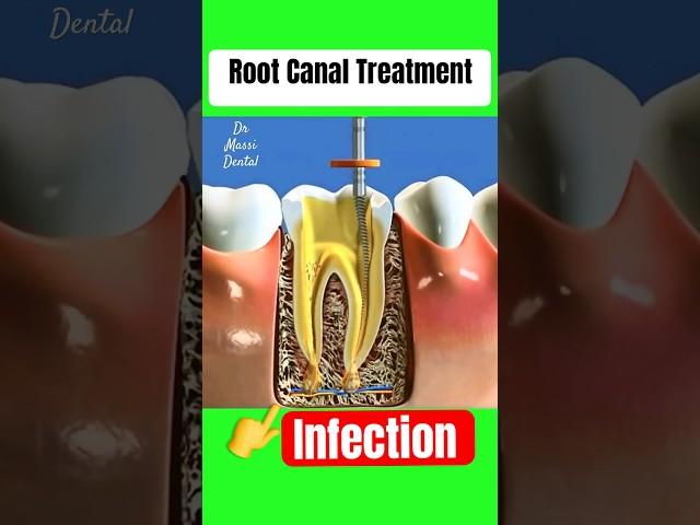 Root Canal Treatment, Infected Tooth Apex