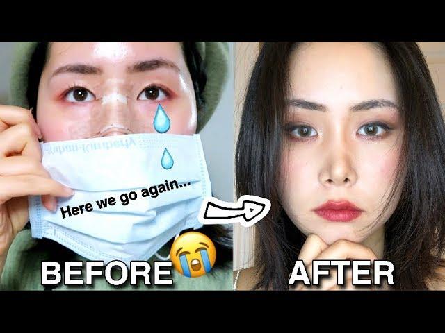 Something BAD Happened To My Nose... | Rhinoplasty Revision Story