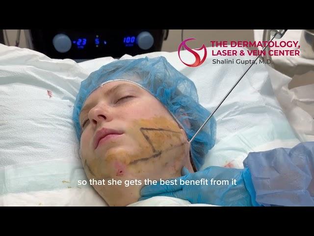 Vaser Liposuction and Facetite for Double Chin | Dr. Shalini Gupta