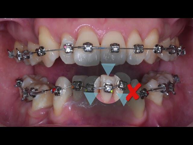 Clinical Tip: Stop Position｜【Chris Chang Ortho】CC439